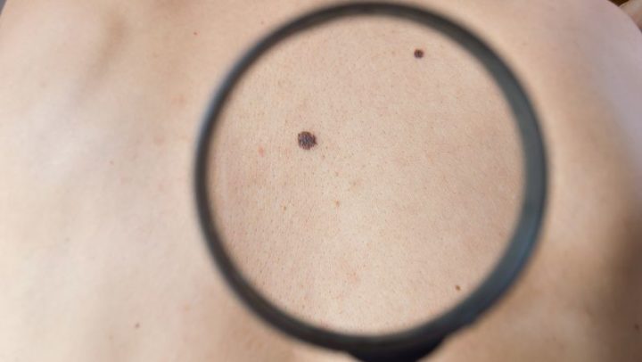 checking melanoma on back of man